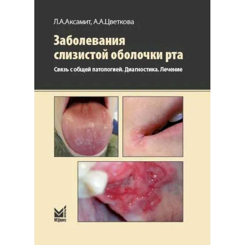 Заболевания слизистой оболочки рта. Связь с общей патологией. Диагностика. Лечение Заболевания слизистой оболочки рта. Связь с общей патологией. Диагностика. Лечение