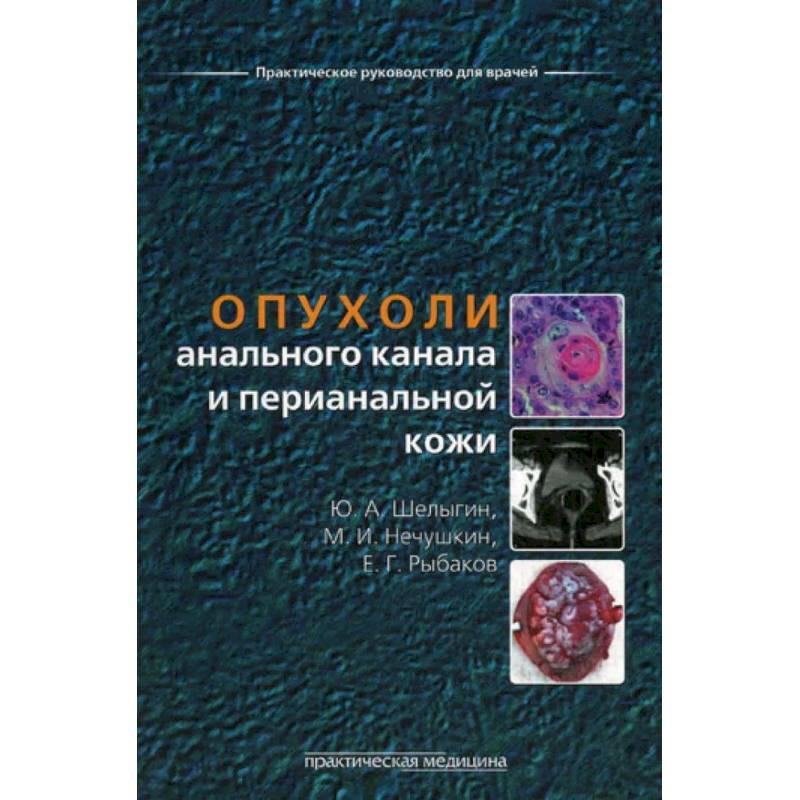 Опухоли анального канала и перианальной кожи Опухоли анального канала и перианальной кожи